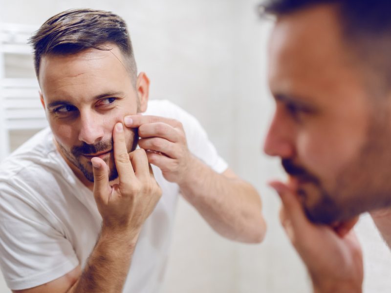 Acne men what causes acne how to get rid treatment neck