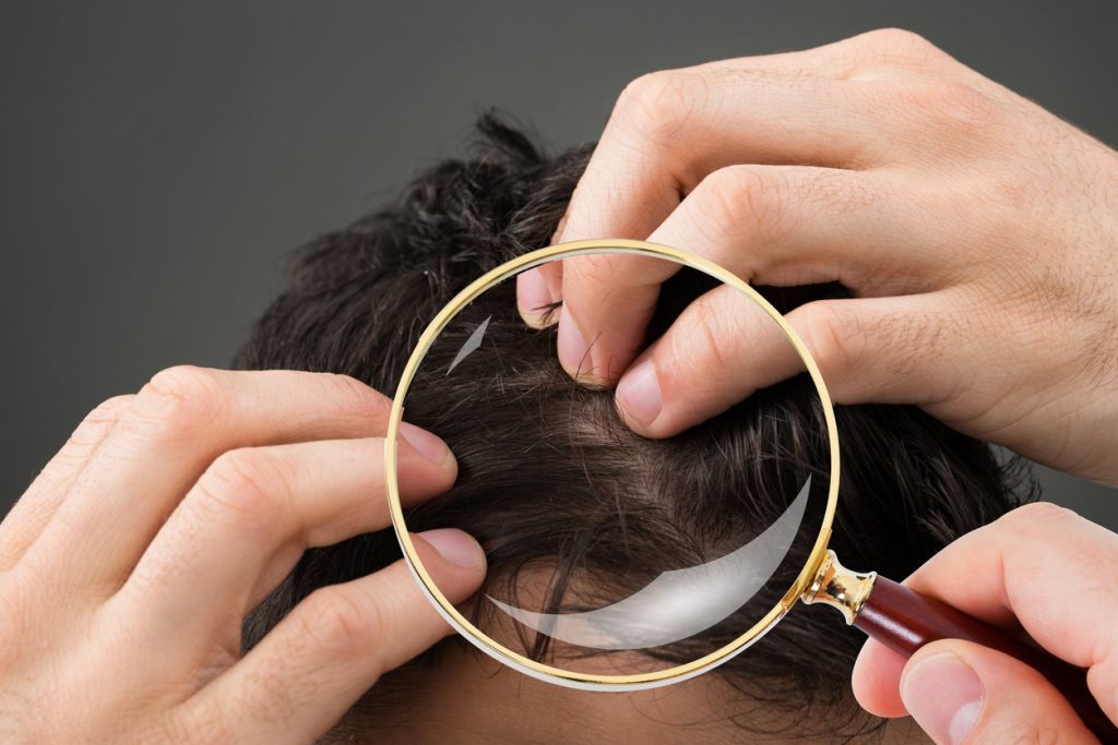 Prevent hair loss men