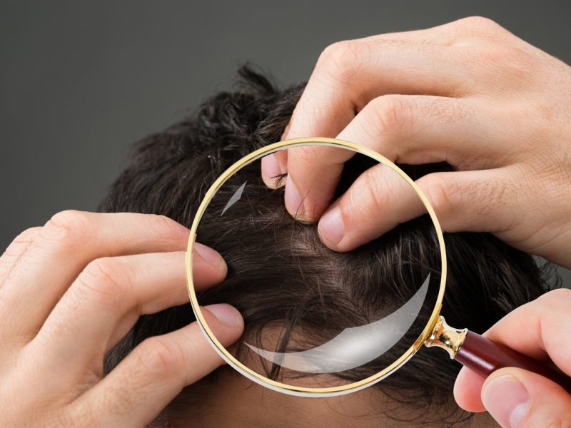Prevent hair loss men