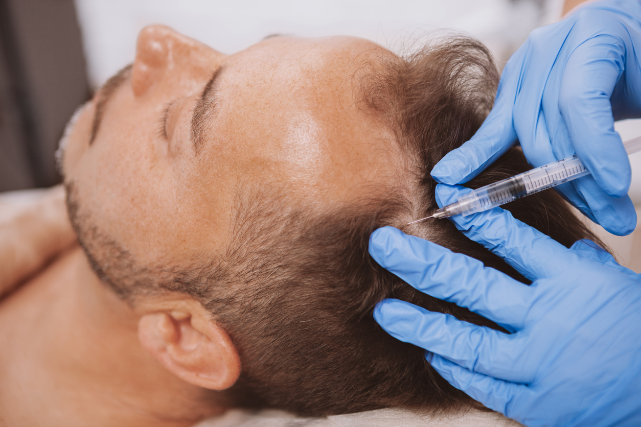 Best hair loss treatment for men UK