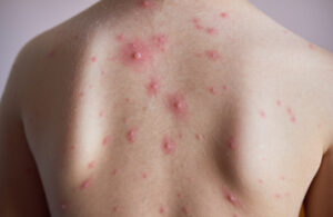 Back acne products causes and treatments