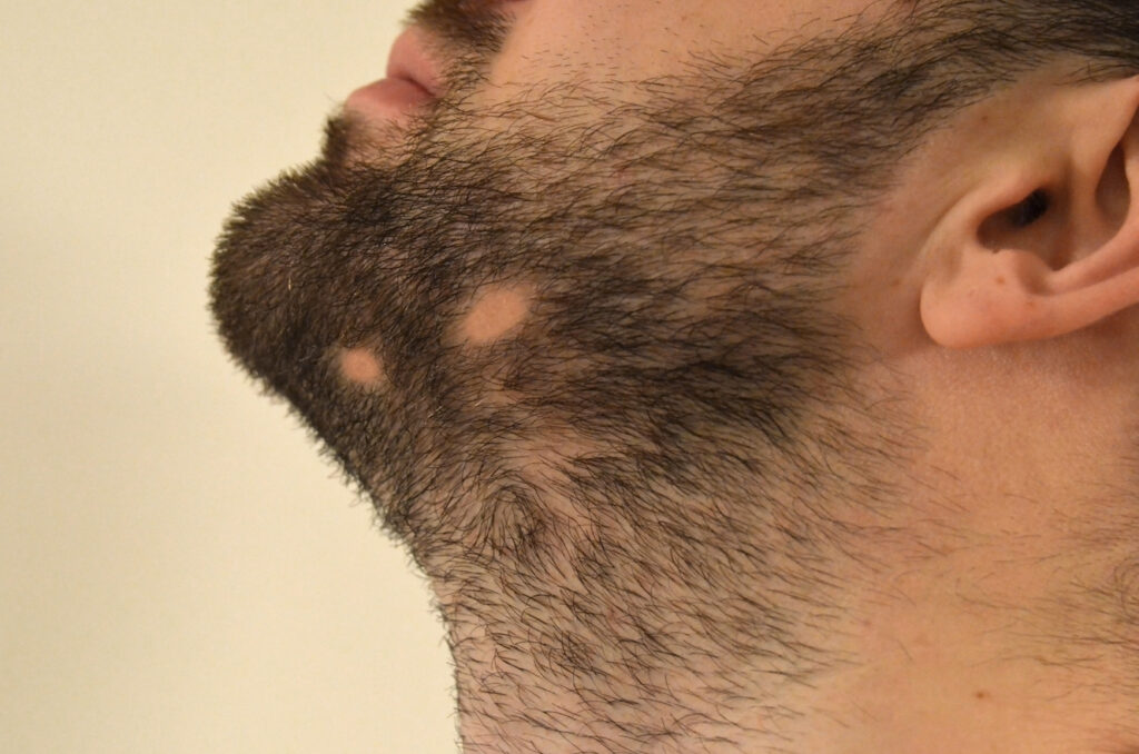 ALopecia-barbae-symptoms-causes-treatments