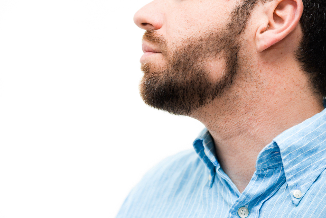 Alopecia barbae: How to treat bald patches in beards and get thicker, fuller facial hair
