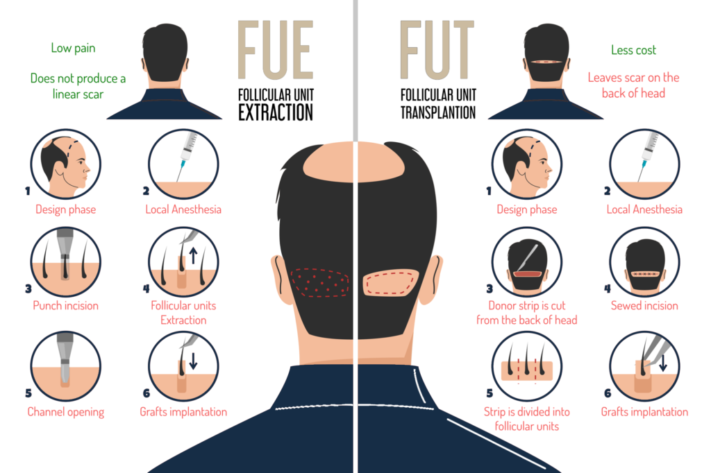 How do hair transplants work FUE vs FUT