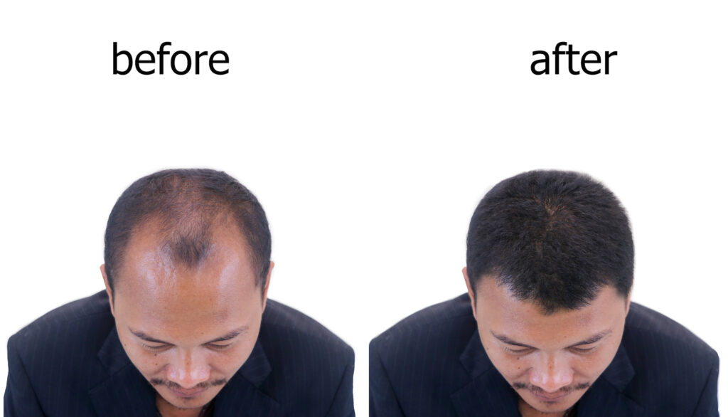 Hair transplant before and after UK