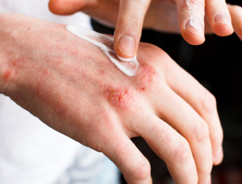 What causes psoriasis and what does psoriasis look like