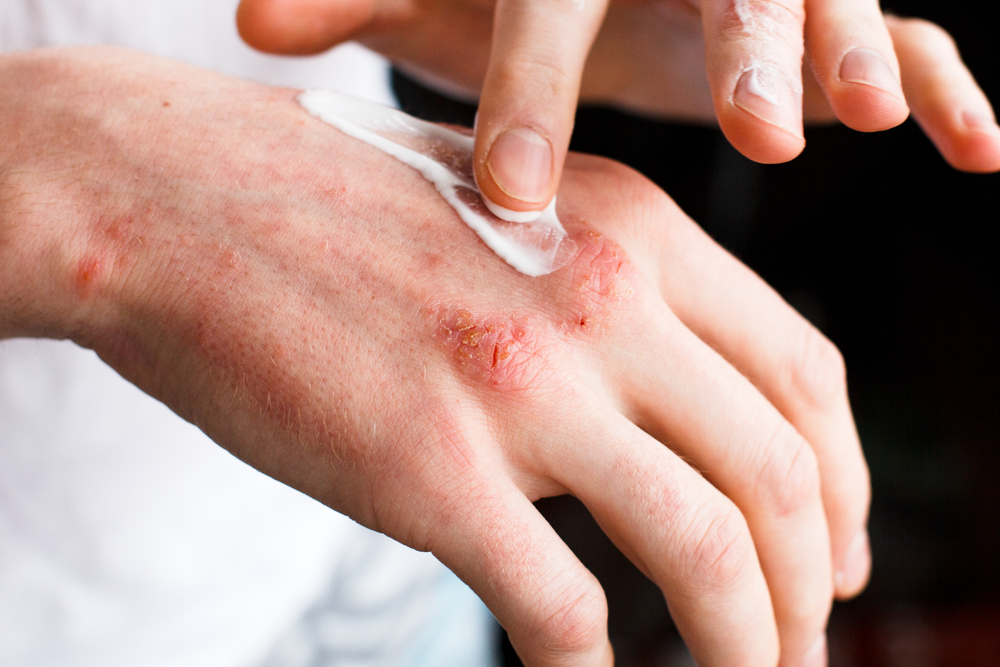 Psoriasis: What causes psoriasis and what does it look like?